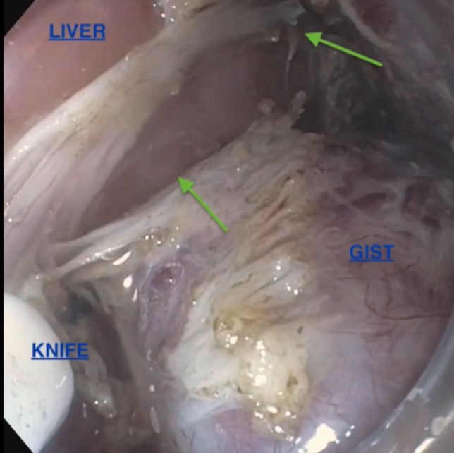 Neil Sharma, M.D. FASGE, FACG, AGAF (@neilrsharmamd) on Twitter photo @EHolzwanger <a href="/BilalMohammadMD/">Mohammad Bilal, MD</a> <a href="/tmhamed/">Turki</a> <a href="/ScopingSundays/">#ScopingSundays</a> <a href="/GowthamiR01/">Gowthami Ramar</a> <a href="/AhmadBazarbashi/">Ahmad N. Bazarbashi أحمد بازارباشي</a> <a href="/CarlKayMD/">Carl Kay, MD</a> <a href="/vaibhav_manu/">Vaibhav Wadhwa</a> <a href="/RobertoSimonsMD/">Roberto Simons-Linares, MD</a> <a href="/JosephHabibi_MD/">Joseph Sleiman, MD, FACP</a> <a href="/AdvaniRashmiMD/">Rashmi Advani, MD, ABOM</a> <a href="/TrieuMD/">Judy Trieu, MD, MPH</a> <a href="/LizzieAbyMD/">Lizzie Aby, MD</a> <a href="/rmulkimd/">Ramzi Mulki, MD</a> <a href="/SyedGerdezi/">Anjum Gardezi MD</a> <a href="/TomTielleman/">Tom Tielleman, MD</a> <a href="/EndoscopyOthman/">Mohamed Othman</a> <a href="/GiJawaid/">Salmaan Jawaid, MD</a> <a href="/SahajRathi/">Sahaj Rathi MD, DM, MRCP</a> <a href="/SanchezLunaMD/">Sergio A. Sánchez-Luna, MD, DABOM (He/Him/His)</a> <a href="/ShyamTMD/">Shyam Thakkar, MD</a> <a href="/DavidDiehlMD/">David Diehl</a> <a href="/BalissMichelle/">Michelle Baliss, DO</a> <a href="/VinayChandraMD/">Vinay Chandrasekhara, MD</a> <a href="/GI_Pearls/">GI Pearls</a> <a href="/Taalamri/">Turki AlAmri |تُرْكي عبدالله الْعَمريَّ MD</a> <a href="/DharJahnvi/">Jahnvi Dhar</a> <a href="/KM_Pawlak/">Katarzyna Monika Pawlak</a> <a href="/gastrowala/">Aziz Aadam</a> <a href="/AgnihotriGI/">Abhishek Agnihotri, MD</a> <a href="/laurenkhanna/">Lauren Khanna</a> <a href="/JovaniManol/">Manol Jovani, MD MPH</a> <a href="/NEndoscopy/">Prof John Leeds</a> <a href="/doc_zubin/">Zubin Sharma MD</a> <a href="/SriGaddamMD/">Srinivas Gaddam, MD, MPH</a> <a href="/thedennischen/">Dennis Chen</a> <a href="/PopovVioleta/">Violeta Popov, MD PhD</a> <a href="/RashidLui/">Rashid Lui 雷諾信</a> <a href="/tberzin/">Tyler Berzin MD, FASGE</a> <a href="/DrSaeeeed/">Ahmed Saeed, MD, DABOM</a> <a href="/Jarshah4/">Raj Shah</a> <a href="/RobertBechara/">Robert Bechara</a> <a href="/MendozaLadd/">Antonio Mendoza Ladd MD, AGAF, FACG, FASGE</a> <a href="/DennisYangMD/">Dennis Yang, MD, FACG,AGAF,FASGE</a> <a href="/MoamenGabrMD/">Moamen Gabr</a> Great dialog!
Some pearls
➡️Gastric GIST more technically difficult to resect via STER
➡️Be prepared for adjacent structures and pneumoperitoneum
➡️consider Gentamycin solution
➡️never injure the capsule
➡️work w pathology & Tumor board when establishing a program
#GITwitter @EHolzwanger <a href="/BilalMohammadMD/">Mohammad Bilal, MD</a> <a href="/tmhamed/">Turki</a> <a href="/ScopingSundays/">#ScopingSundays</a> <a href="/GowthamiR01/">Gowthami Ramar</a> <a href="/AhmadBazarbashi/">Ahmad N. Bazarbashi أحمد بازارباشي</a> <a href="/CarlKayMD/">Carl Kay, MD</a> <a href="/vaibhav_manu/">Vaibhav Wadhwa</a> <a href="/RobertoSimonsMD/">Roberto Simons-Linares, MD</a> <a href="/JosephHabibi_MD/">Joseph Sleiman, MD, FACP</a> <a href="/AdvaniRashmiMD/">Rashmi Advani, MD, ABOM</a> <a href="/TrieuMD/">Judy Trieu, MD, MPH</a> <a href="/LizzieAbyMD/">Lizzie Aby, MD</a> <a href="/rmulkimd/">Ramzi Mulki, MD</a> <a href="/SyedGerdezi/">Anjum Gardezi MD</a> <a href="/TomTielleman/">Tom Tielleman, MD</a> <a href="/EndoscopyOthman/">Mohamed Othman</a> <a href="/GiJawaid/">Salmaan Jawaid, MD</a> <a href="/SahajRathi/">Sahaj Rathi MD, DM, MRCP</a> <a href="/SanchezLunaMD/">Sergio A. Sánchez-Luna, MD, DABOM (He/Him/His)</a> <a href="/ShyamTMD/">Shyam Thakkar, MD</a> <a href="/DavidDiehlMD/">David Diehl</a> <a href="/BalissMichelle/">Michelle Baliss, DO</a> <a href="/VinayChandraMD/">Vinay Chandrasekhara, MD</a> <a href="/GI_Pearls/">GI Pearls</a> <a href="/Taalamri/">Turki AlAmri |تُرْكي عبدالله الْعَمريَّ MD</a> <a href="/DharJahnvi/">Jahnvi Dhar</a> <a href="/KM_Pawlak/">Katarzyna Monika Pawlak</a> <a href="/gastrowala/">Aziz Aadam</a> <a href="/AgnihotriGI/">Abhishek Agnihotri, MD</a> <a href="/laurenkhanna/">Lauren Khanna</a> <a href="/JovaniManol/">Manol Jovani, MD MPH</a> <a href="/NEndoscopy/">Prof John Leeds</a> <a href="/doc_zubin/">Zubin Sharma MD</a> <a href="/SriGaddamMD/">Srinivas Gaddam, MD, MPH</a> <a href="/thedennischen/">Dennis Chen</a> <a href="/PopovVioleta/">Violeta Popov, MD PhD</a> <a href="/RashidLui/">Rashid Lui 雷諾信</a> <a href="/tberzin/">Tyler Berzin MD, FASGE</a> <a href="/DrSaeeeed/">Ahmed Saeed, MD, DABOM</a> <a href="/Jarshah4/">Raj Shah</a> <a href="/RobertBechara/">Robert Bechara</a> <a href="/MendozaLadd/">Antonio Mendoza Ladd MD, AGAF, FACG, FASGE</a> <a href="/DennisYangMD/">Dennis Yang, MD, FACG,AGAF,FASGE</a> <a href="/MoamenGabrMD/">Moamen Gabr</a> Great dialog!
Some pearls
➡️Gastric GIST more technically difficult to resect via STER
➡️Be prepared for adjacent structures and pneumoperitoneum
➡️consider Gentamycin solution
➡️never injure the capsule
➡️work w pathology & Tumor board when establishing a program
#GITwitter