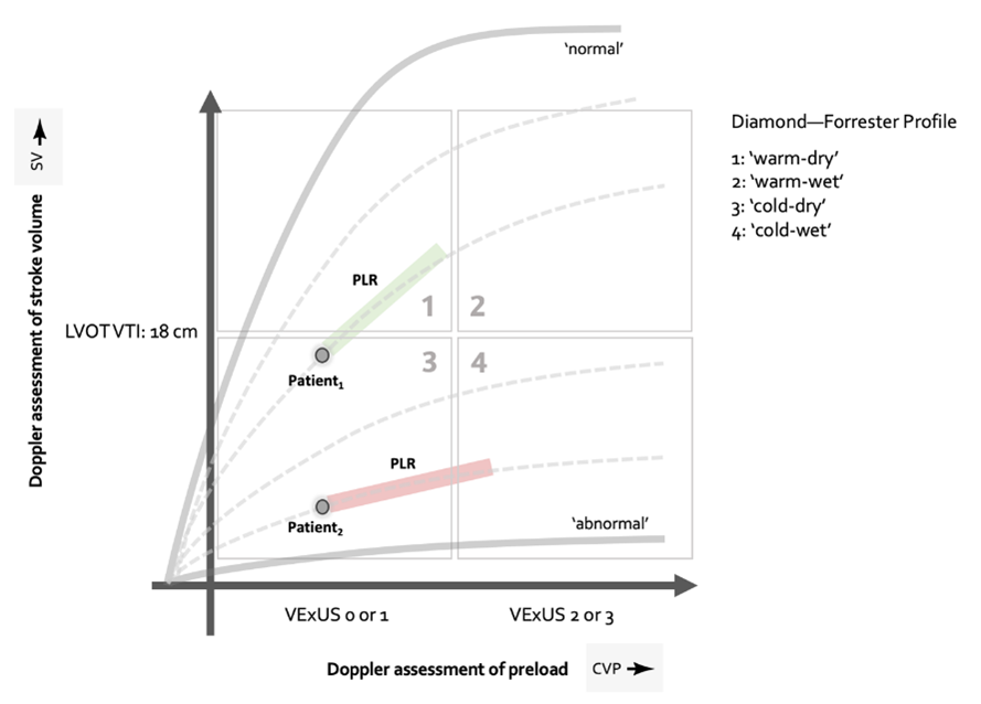 Ross Prager (@ross_prager) on Twitter photo We know about fluid responsiveness + fluid tolerance, but what about dynamic fluid intolerance? This is a new concept that <a href="/heart_lung/">Jon-Emile Kenny</a> et al. described: pts. can be not-congested, but on a preload challenge (fluid bolus or passive leg raise) they demonstrate congestion. A đź§µ We know about fluid responsiveness + fluid tolerance, but what about dynamic fluid intolerance? This is a new concept that <a href="/heart_lung/">Jon-Emile Kenny</a> et al. described: pts. can be not-congested, but on a preload challenge (fluid bolus or passive leg raise) they demonstrate congestion. A đź§µ