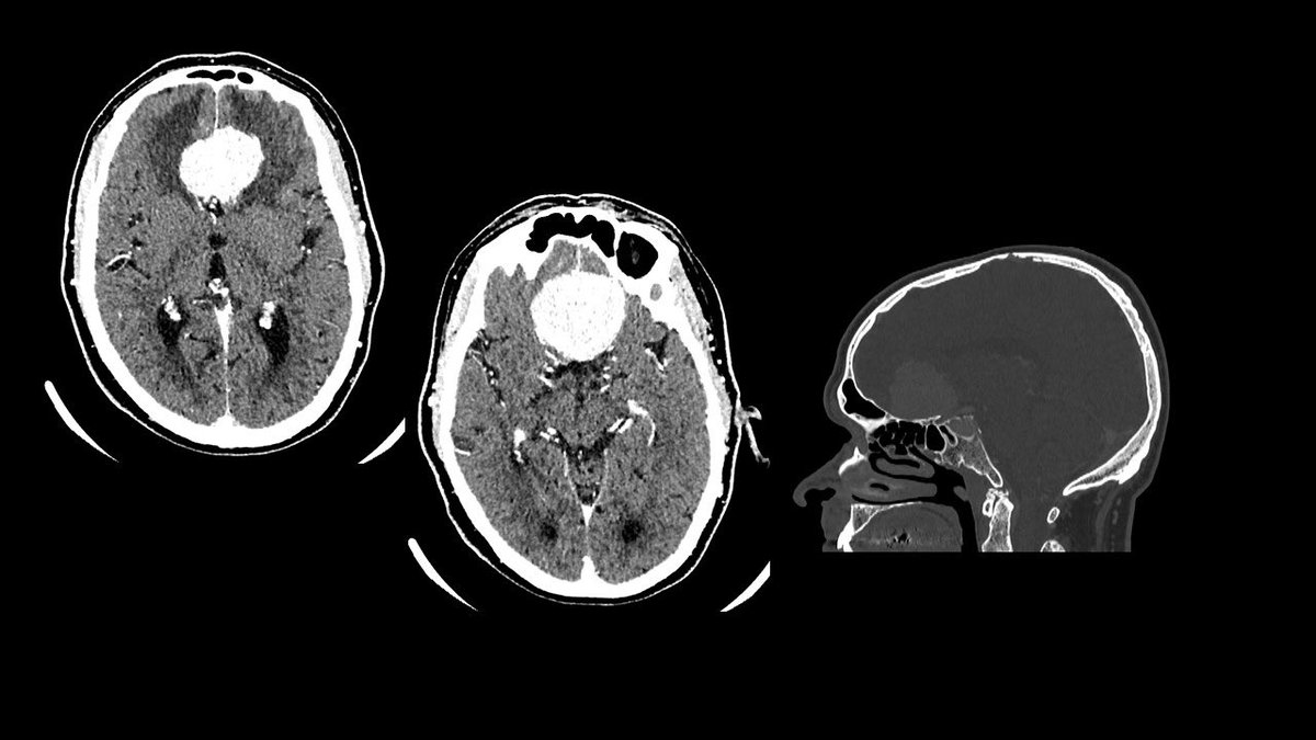 68 m px with anosmia, temp hemianopia & bilat visual acuity impairment. 

Olfactory groove meningioma. 

#skullbase #nsgy