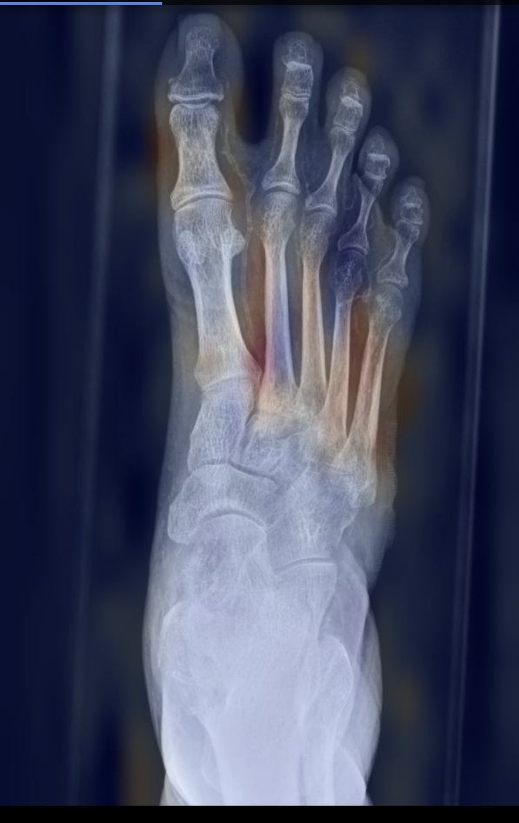 olly_harness's tweet photo. Final mark in for diss. means the end of MSc Artificial Intelligence with Distinction. Publication hopefully to follow to highlight this as example of lower limb feature detection using plain film x-rays and CNN models. Example using open source x-ray. #podiatry #ai @RoyColPod https://t.co/oSZW1UA3xZ
