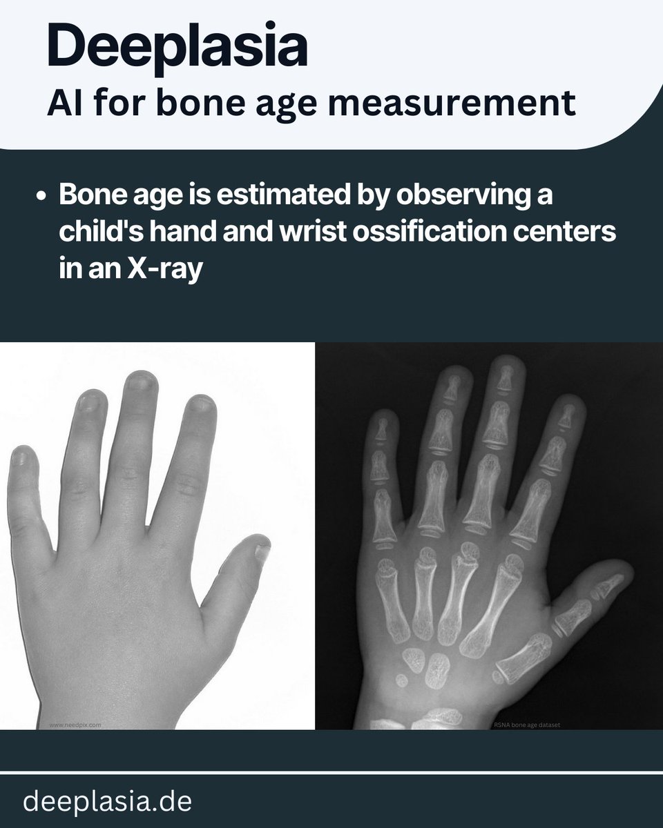 We've developed an open-source AI, Deeplasia, for the high-precision measurement of children's bone age—an important indicator of skeletal and biological maturity. Visit the project website (deeplasia.de) for more info ... (1/4)
#AI #digitalmedicine #deeplearning