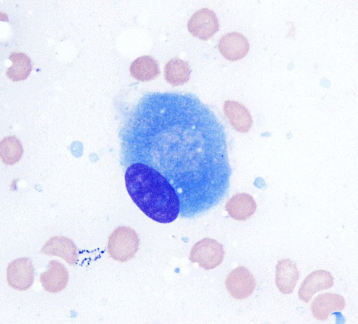 Path4People's tweet photo. I can sometimes get confused for Plasma Cell Myeloma on Cyto
I like to build and use my special “cement”, hydroxyapatite
Who am I?
#pathagonia #pathx #orthox #orthopedics #medstudentx #boneandsofttissue #histox #science #medx #cytox https://t.co/kTz5baSIVp