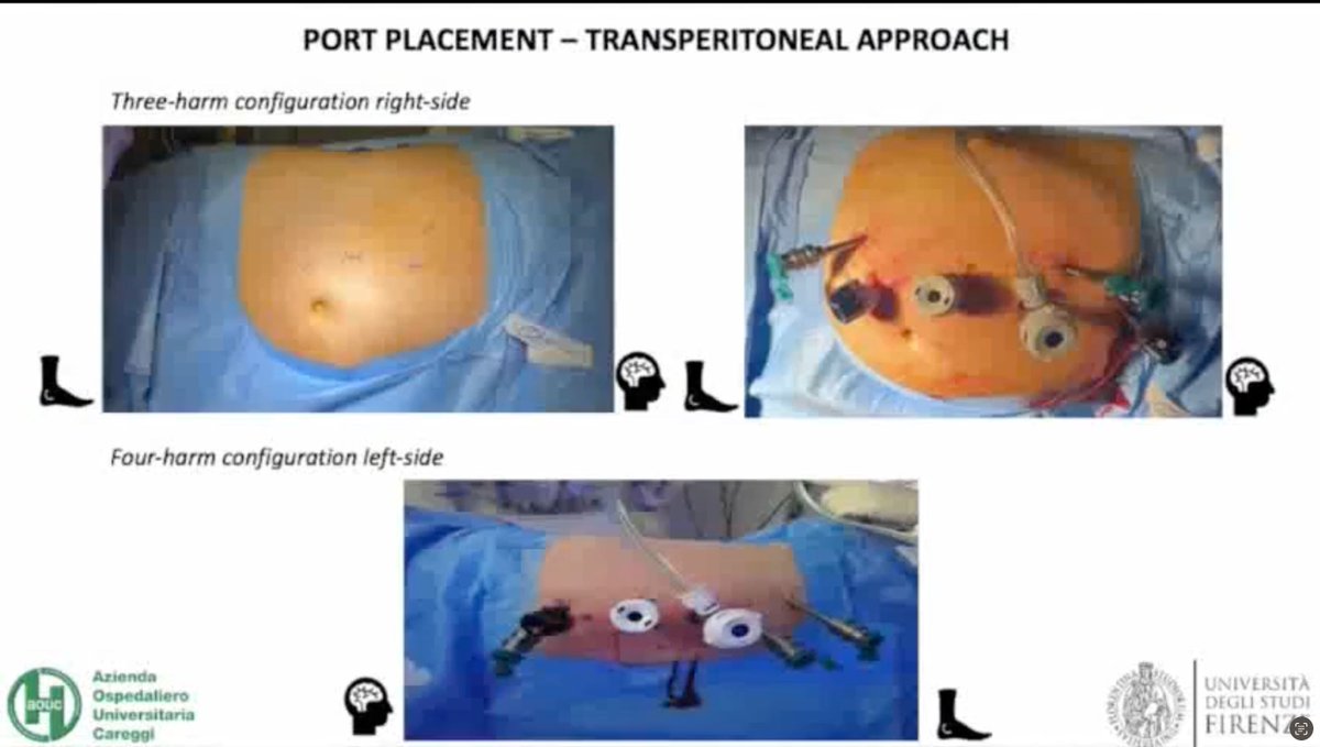 Surgery in Motion: Redo Partial Nephrectomy for Local Recurrence After Previous Nephron-sparing Surgery. Surgical Insights and Oncologic Results from a High-volume Robotic Center 

buff.ly/40Q6c1I 

#openaccess #openscience #Medtwitter