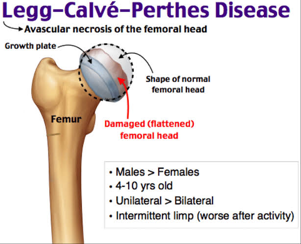 <a href="/BrownJHM/">Journal of Brown Hospital Medicine</a> <a href="/Radiopaedia/">Radiopaedia.org</a> Perthes disease are: femoral head deformity with widening and flattening (coxa plana) proximal femoral neck deformity: coxa magna. "sagging rope sign" (thin sclerotic line running across the femoral neck)