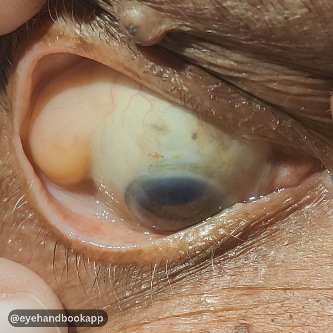 What is your diagnosis?
Check ALT (image description) for more info.

#eyes #clinicalcalculators #eyecalculators #cataract #eyeatlas #ophthalmologist #optometrist #eyedoctors #ophthalmology #optometry #cornea #ophthalmologyresident #retina #optometryresident #oftalmologia #free