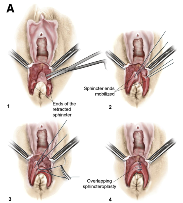 AJOG_thegray's tweet photo. AJOG Expert Review in Labor:  Repair of episiotomy and obstetrical perineal lacerations (first-fourth) - Overlapping sphincteroplasty technique https://t.co/Jx6FzEgxrp https://t.co/WfwCCyF69h