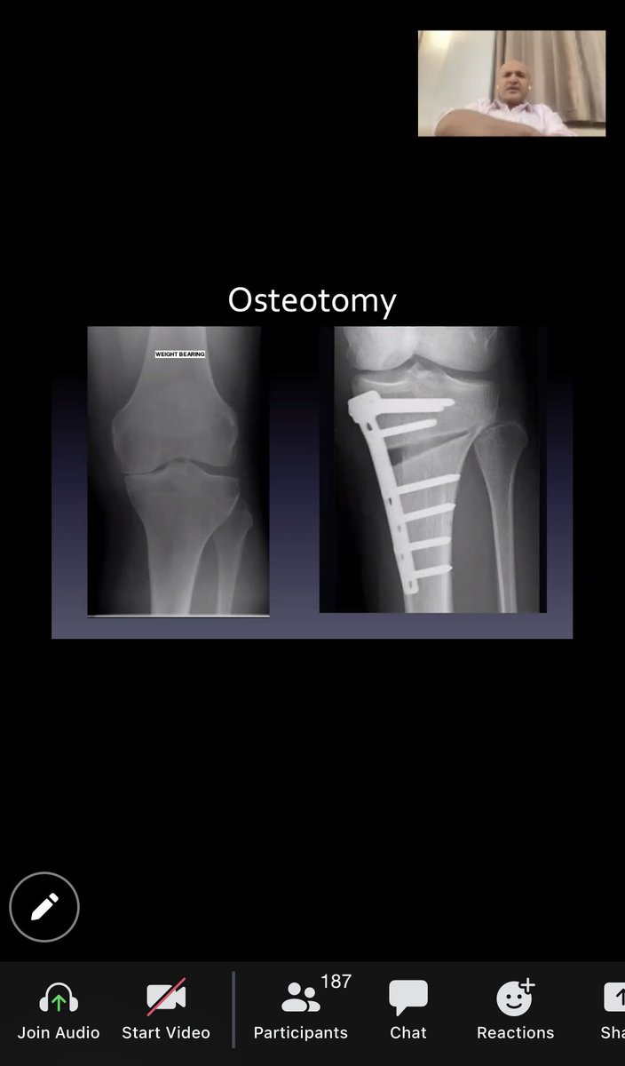 MidlandOrth's tweet photo. ✅ A great interactive online zoom webinar this evening with Mr Hussain, who gave an informative talk on Knees- Breaking the Myths!
Our Jan- March 2024 dates are being planned.
To register your interest email michelle@midlandorthopaedicpractice.co.uk #knees #BKSC #GP #FCP https://t.co/BkXolfOxQf