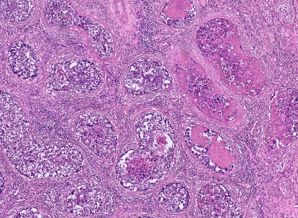 DrLaurenceGalea's tweet image. Radical orchidectomy

Intratubular embryonal carcinoma with necrosis (in images)

There was adjacent mixed germ cell tumour including embryonal carcinoma

#PathTwitter #Pathology #PathResidents #GUPath