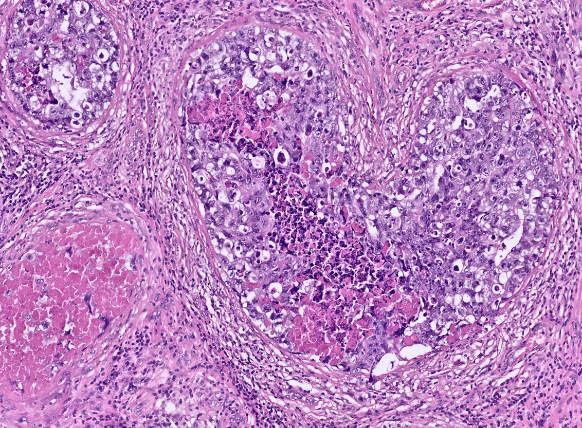 DrLaurenceGalea's tweet image. Radical orchidectomy

Intratubular embryonal carcinoma with necrosis (in images)

There was adjacent mixed germ cell tumour including embryonal carcinoma

#PathTwitter #Pathology #PathResidents #GUPath