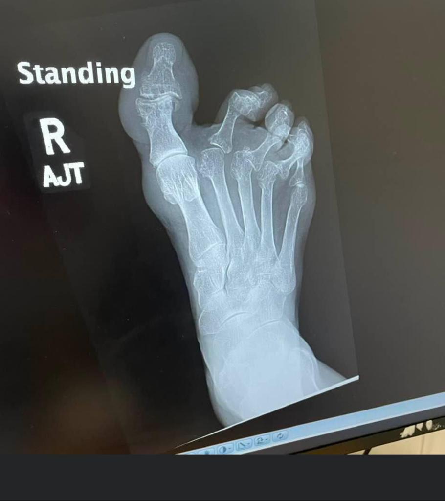 SabrinaDe_Souza's tweet photo. Thread: This is an x-ray of my mum’s foot.

Her hands &amp; feet bear the deformities of 40 years of living with #rheumatoidarthritis. 

Diagnosed at 24 years old, RA stole her youth, but not her dignity. 

Each day is a silent war against pain, one she conceals with unwavering grace https://t.co/gOWBhtVHhD