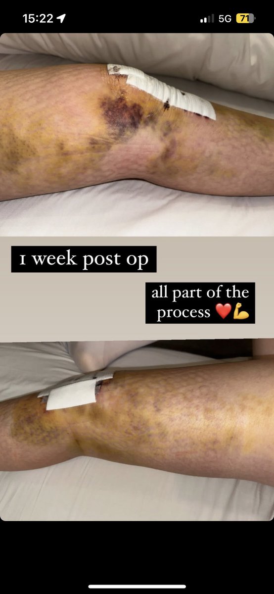 NWgameready's tweet image. Game Ready cold compression is proven to ease pain, reduce swelling and accelerate recovery. If you’ve orthopaedic surgery booked, drop use a message and discover the power of game ready.
#acl #orthopedics #kneerehab #physio #aclrehab #aclsurgery #returntoplay #neymarjr #soccer