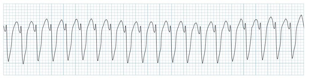 JagomezR_MD's tweet photo. Mi paciente tiene una taquicardia ventricular en urgencias 🚨 
¿Qué hago? 👇 

Aquí te muestro los pasos del algoritmo de la guía europea 2022 de arritmias ventriculares. 
#MedTwitter #Cardiotwitter https://t.co/GZUpY9zVFA