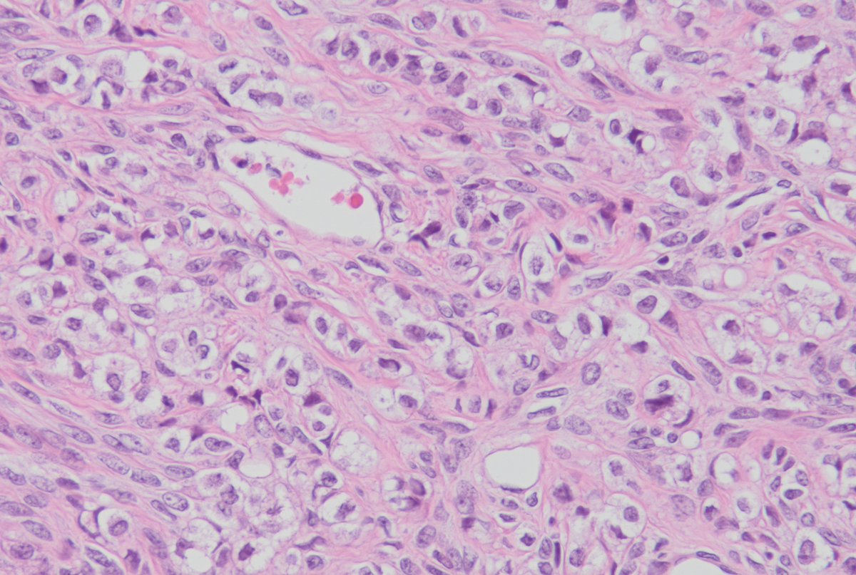 🖊️Ovary, adult

#gynpath #GIpath #pathtwitter #pathresidents