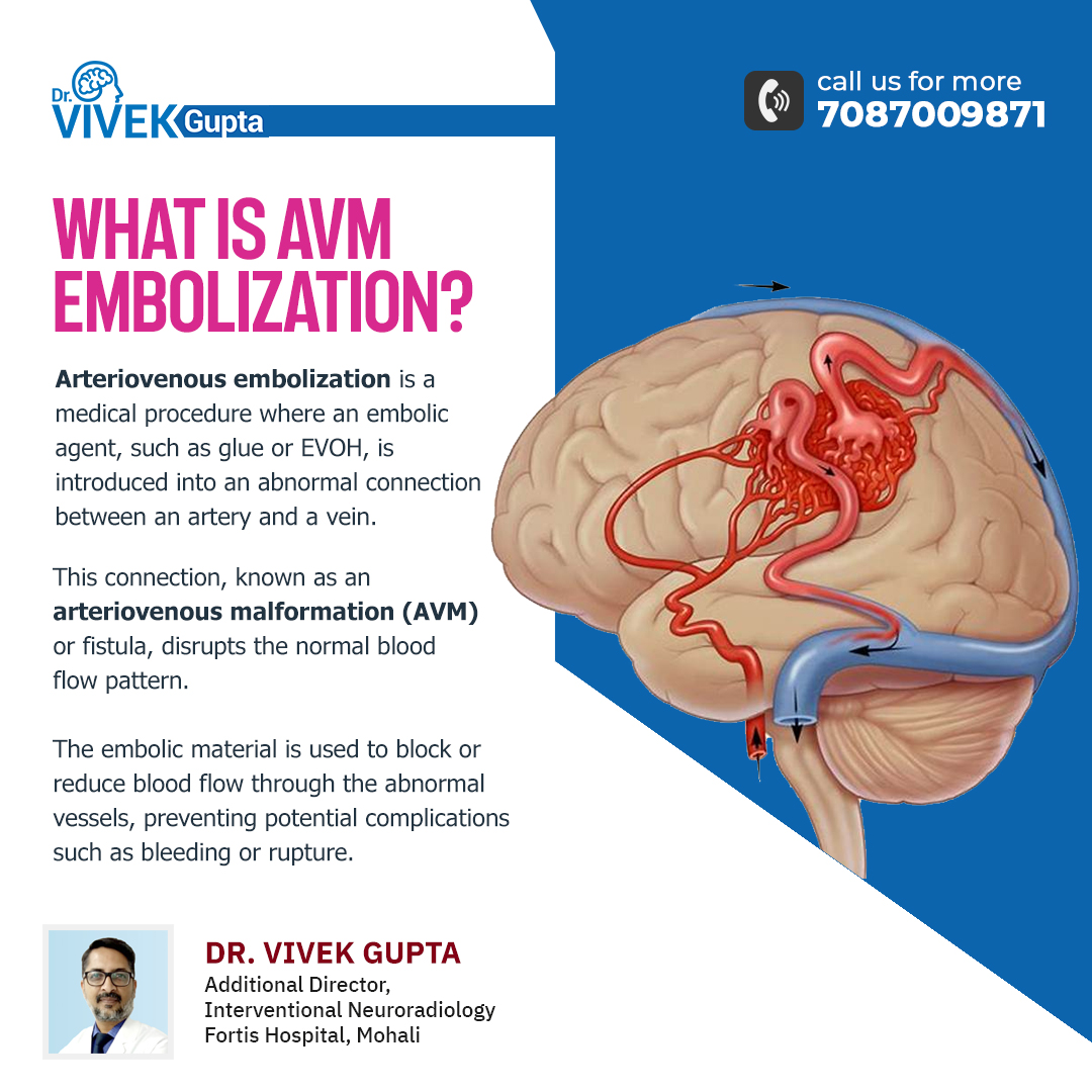 doctorvivekg's tweet photo. Unlocking the power of medicine. Arteriovenous Embolization is a cutting-edge procedure, that uses Glue, and EVOH sometimes with coils to tackle abnormal artery-vein connections.
https://t.co/a8JXh8pUop
#ArteriovenousEmbolization #AVMEmbolization #EVOH #arteriovenousmalformation https://t.co/APbE4NX44A
