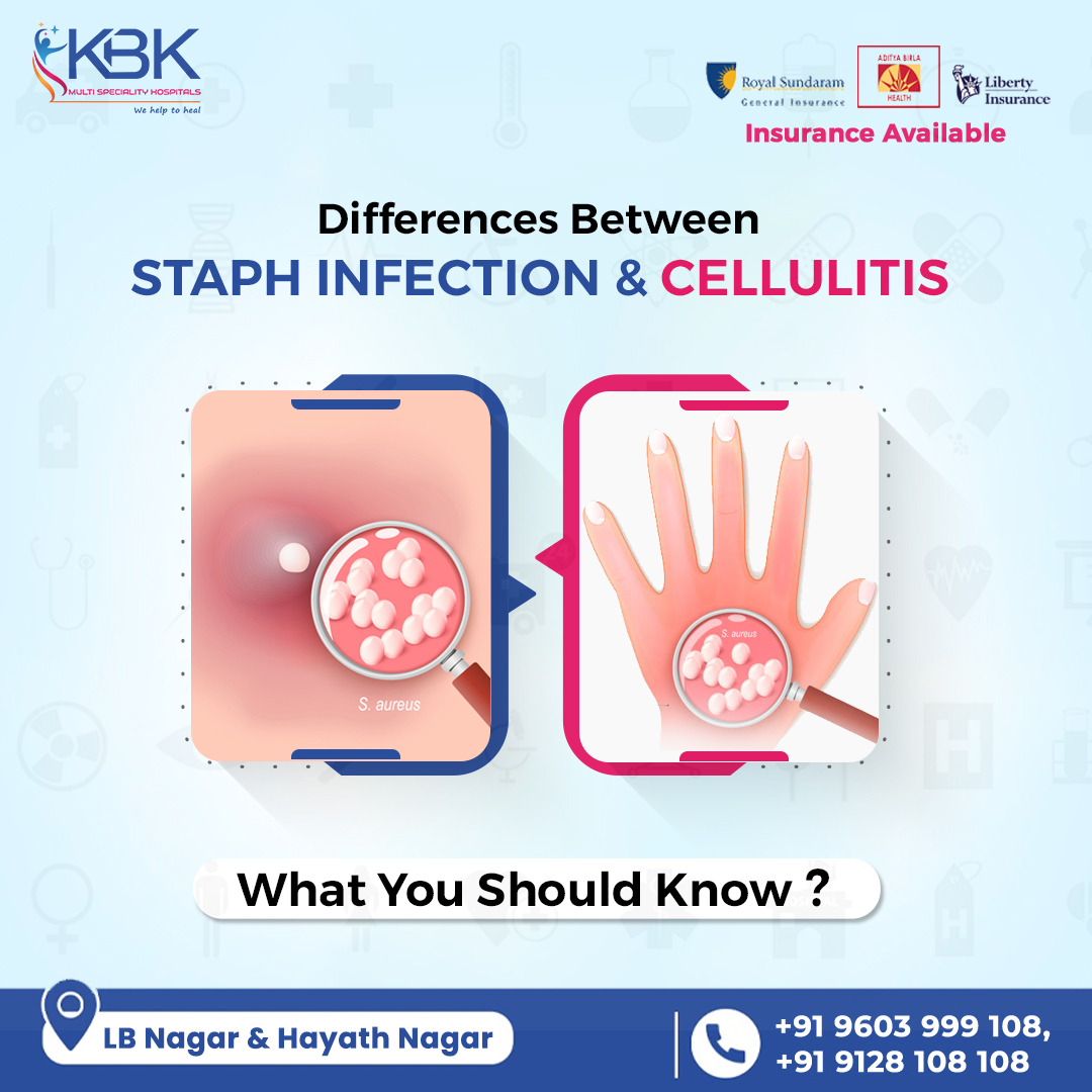 #StaphylococcusAureus, or #Staph #Aureus, is a type of #Skin #bacteria. It is mostly set up on the skin & nose.

#StaphAureus #treatment consists of various antibiotics.

Link for more:
surl.li/nmszh

Call @ +91 9603999108, 9128108108

#kbkgroup #kbkhospitals #hyderabad