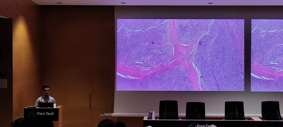 PathTauli's tweet photo. Continúa el Dr. Quiceno Arias de la Fundación Jimenez Diaz con un tumor SETTLE de tiroides y su diagnóstico diferencial. 🔬 https://t.co/fXfru891fl
