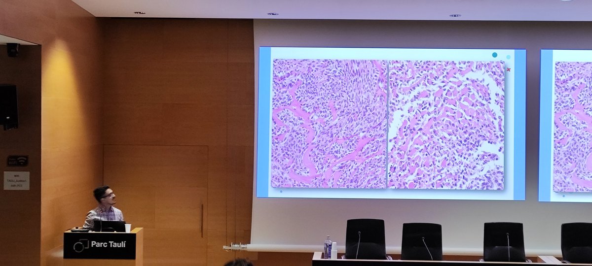 PathTauli's tweet photo. Continúa el Dr. Quiceno Arias de la Fundación Jimenez Diaz con un tumor SETTLE de tiroides y su diagnóstico diferencial. 🔬 https://t.co/fXfru891fl