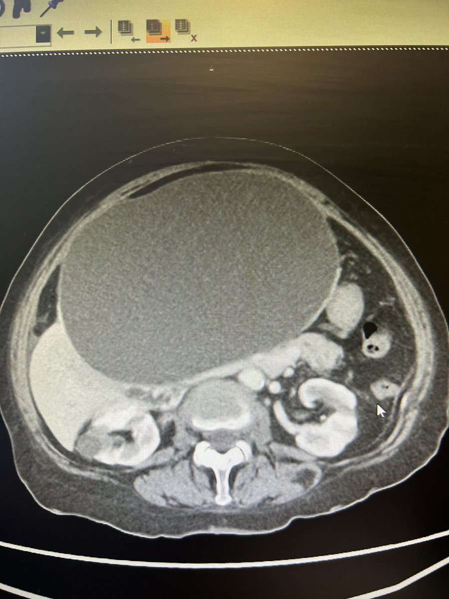 Marek Czajkowski (@captcholangio) on Twitter photo Hey <a href="/EndoCollabcom/">EndoCollab™ | GI Endoscopy Community</a> <a href="/helpatologist/">Nadeem Tehami</a> <a href="/NEndoscopy/">Prof John Leeds</a> who would LAMS this? (It’s a liver cyst in a relatively asymptomatic fit and well 68yo with negative echinococcus serology) Hey <a href="/EndoCollabcom/">EndoCollab™ | GI Endoscopy Community</a> <a href="/helpatologist/">Nadeem Tehami</a> <a href="/NEndoscopy/">Prof John Leeds</a> who would LAMS this? (It’s a liver cyst in a relatively asymptomatic fit and well 68yo with negative echinococcus serology)
