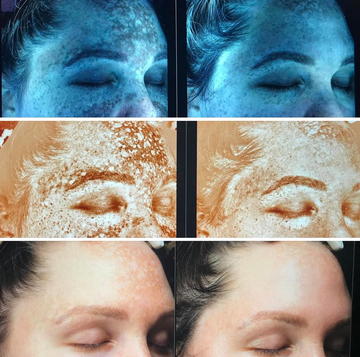 aamedispa's tweet photo. Black🖤Friday Deal 8am -11am ONLY‼️

This 🧪Peel includes: 
➡️7-10 days of downtime‼️
➡️A VISIA Skin Analysis before &amp; post treatment‼️
➡️A  7 day follow up Oxygen Treatment‼️

Today’s price: $99
Regular price: $275
Savings: $176

📲To order call (606)326-0166 https://t.co/pge4cIYRrA
