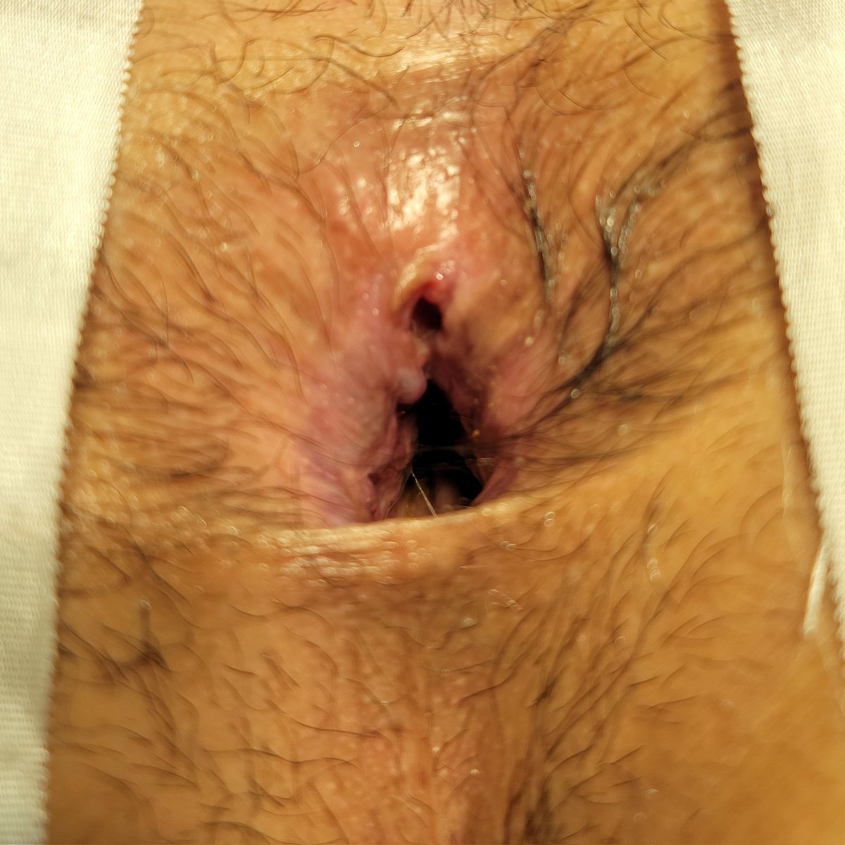 ColoproctologoD's tweet photo. ¿Logras ver la fisura anal? #Proctogalería https://t.co/iEItfBxIX3