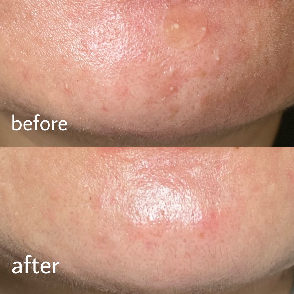 chubbysine_'s tweet image. ก่อนหน้านี้สิวขึ้นไม่หยุดเลย ลดของมันของทอดแล้วก็ยังไม่หาย กินวิตามินตัวนี้คือดี วันละ 2 เม็ดก่อนนอน ตรงคางดีขึ้น สิวอักเสบยุบลง หน้ามันน้อยลงด้วย ต้องกินต่อเนื่องน้าถึงจะเห็นผล  ช่วงนี้แฮปปี้สุดๆ หน้าดีขึ้นแล้ว  #nectapharma #ใช้ดีบอกต่อสิว