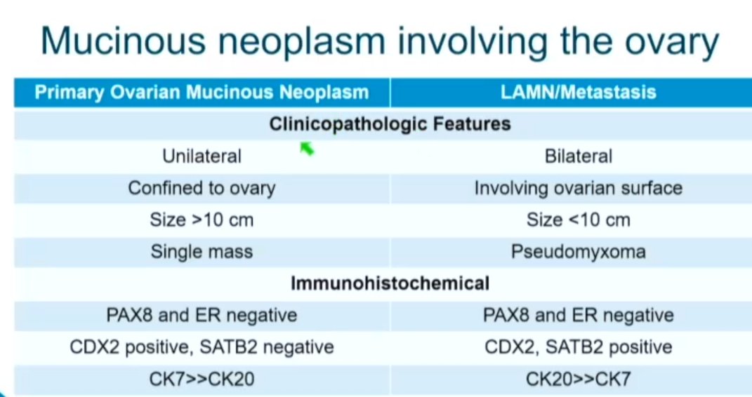 Janiranavarro's tweet photo. Mucinous neoplasms involving the ovary
-Difficult to classify it as LAMN involving the ovary without having the appendix for evaluation.
-It would be ideal to have the appendix available for evaluation in all these cases
Dr. Umetsu #CAP23  #GIpath #PathX #PathTwitter #pathology https://t.co/nyH84o1EgD
