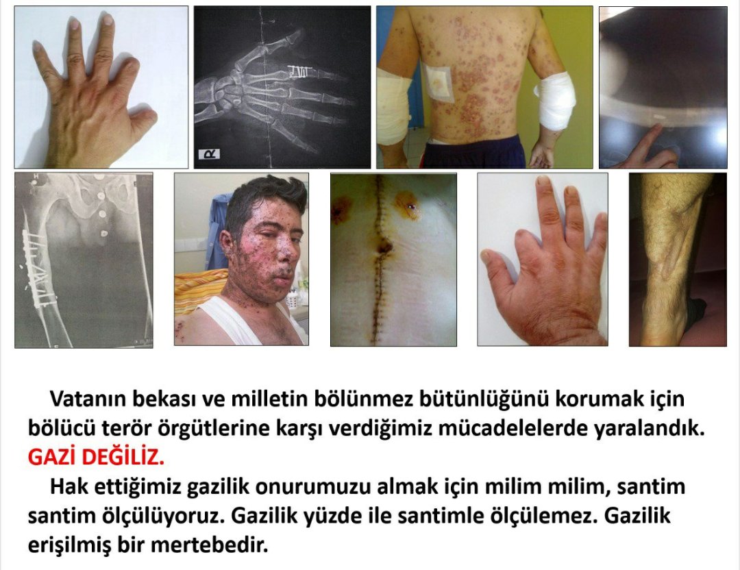 #GazilikHakkımızıİstiyoruz
Vatan savunmasıda Kurşun şarapnel yedik..TERÖRDEN YARALANIP GAZİ SAYILMAYANLAR 
Gazlik onurunu  istiyor
<a href="/RTErdogan/">Recep Tayyip Erdoğan</a>
<a href="/dbdevletbahceli/">Devlet Bahçeli</a>
<a href="/eczozgurozel/">Özgür Özel</a>
<a href="/meral_aksener/">Meral Akşener</a>
<a href="/MahinurOzdemir/">Mahinur Özdemir Göktaş</a>
<a href="/mustafasenbd/">MUSTAFA ŞEN</a>
<a href="/deryayanikashb/">Derya Yanık</a>
<a href="/avfatmaoncu/">Av.Fatma Öncü</a>
<a href="/celebimehmeta/">Mehmet Ali Çelebi</a>
@Av_Burcu03
