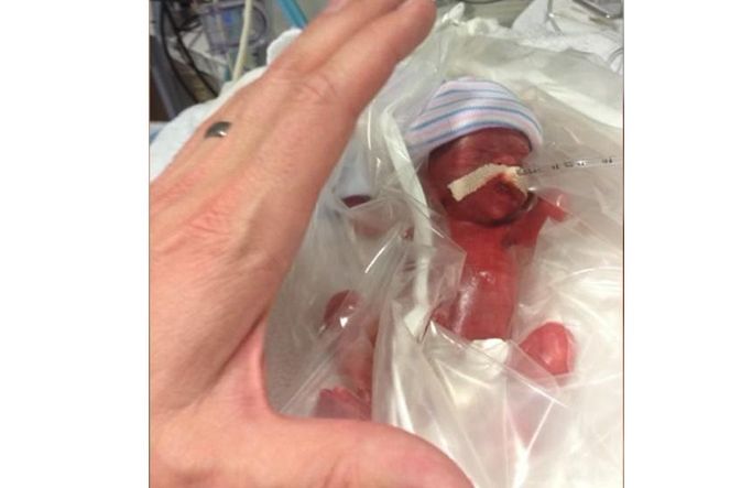 Doctors Said Little Naomi Was So Premature There Was No Hope for Her, But Her Parents Prayed buff.ly/2PTuaYG
