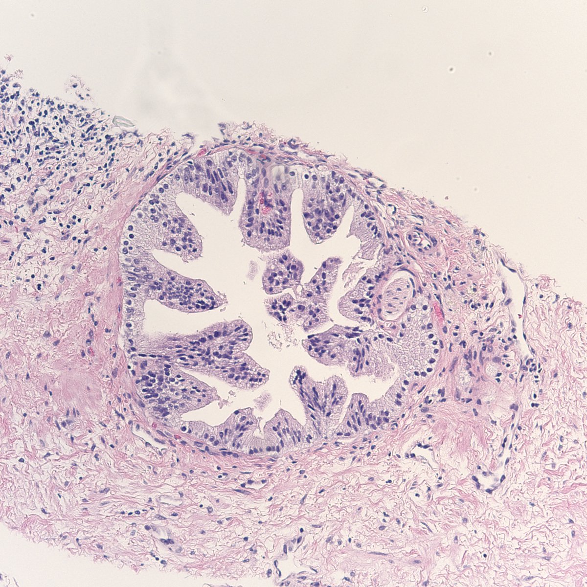 cygupath_md's tweet photo. Huh, this looks like LG-PIN at the very most. But it doesn't have any basal cells, so it is actually the very deceptive PIN-like hyperplastic prostatic adenoCA with perineural invasion. #surgpath #pathX #pathtwitter #pathology #pathologists #gupath #cancer #prostate https://t.co/sVhtUmjAZj
