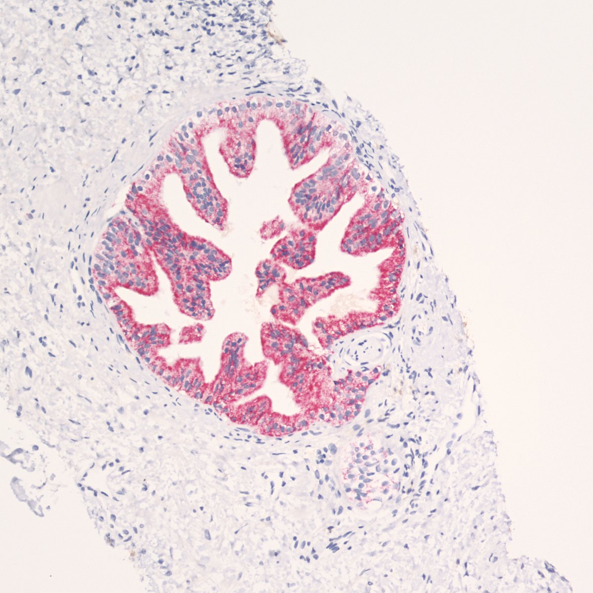 cygupath_md's tweet photo. Huh, this looks like LG-PIN at the very most. But it doesn't have any basal cells, so it is actually the very deceptive PIN-like hyperplastic prostatic adenoCA with perineural invasion. #surgpath #pathX #pathtwitter #pathology #pathologists #gupath #cancer #prostate https://t.co/sVhtUmjAZj