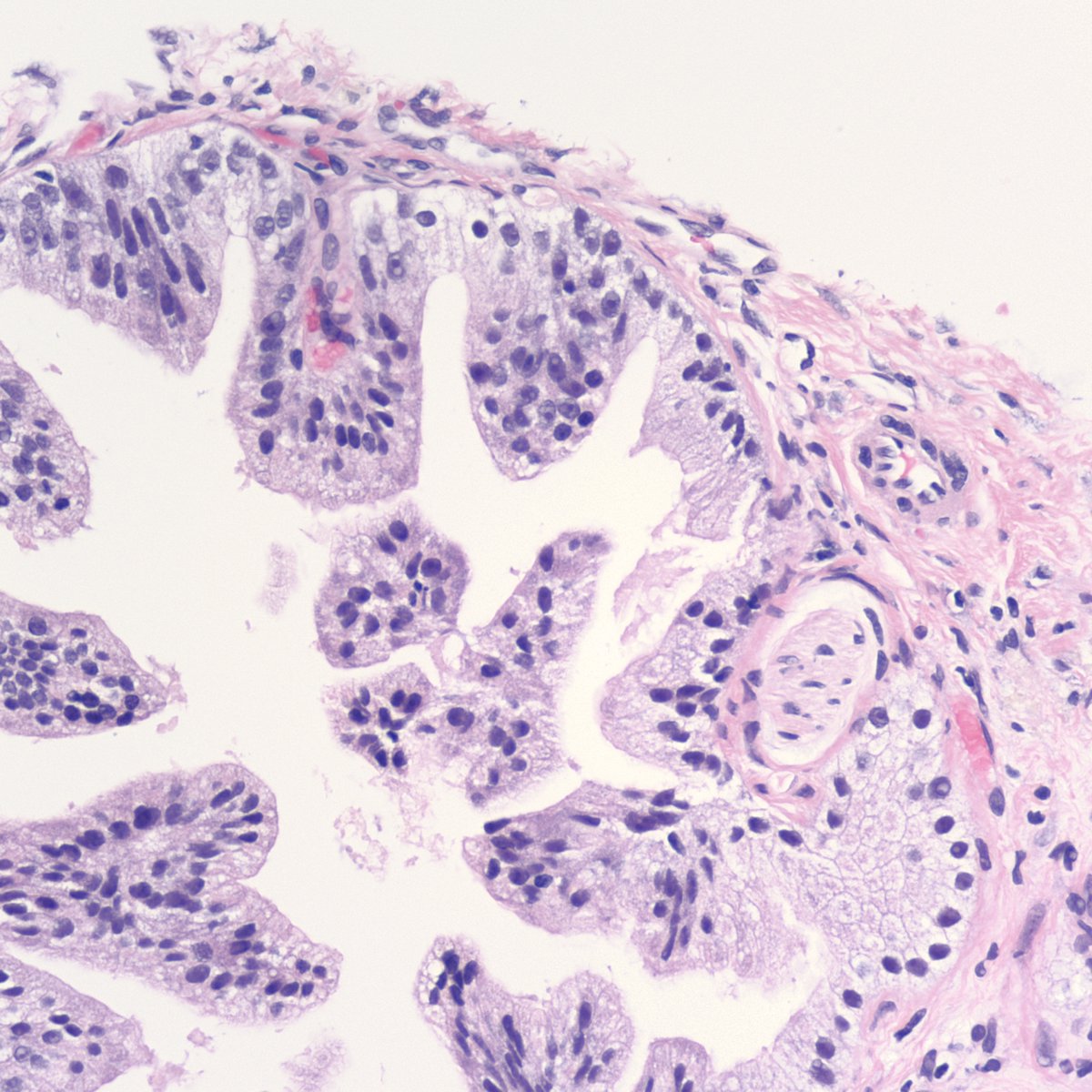 cygupath_md's tweet photo. Huh, this looks like LG-PIN at the very most. But it doesn't have any basal cells, so it is actually the very deceptive PIN-like hyperplastic prostatic adenoCA with perineural invasion. #surgpath #pathX #pathtwitter #pathology #pathologists #gupath #cancer #prostate https://t.co/sVhtUmjAZj