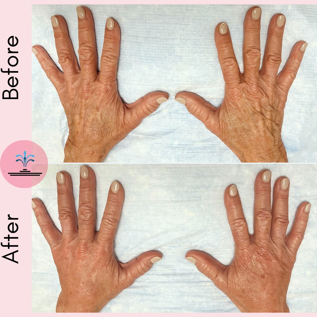 💥FILLER FRIDAY💥 HOLY HANDS! Treated with PRP and Vollure, Compliments of our Master Injector, Pamela. #PRP #Allergan #Filler #Hands #Handrejuvenation #Youthful #Injector #CosmeticProcedures