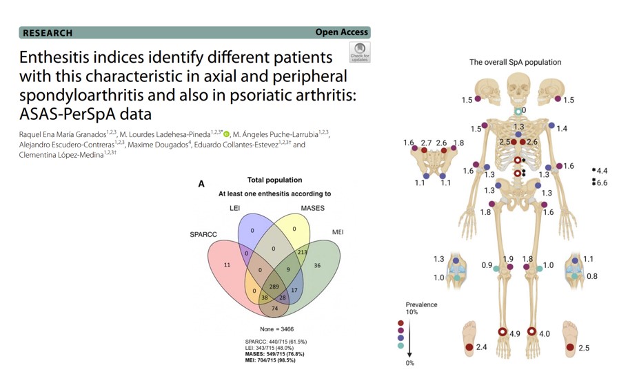 ASAS #PerSpA publication Findings: Prevalence of patients with enthesitis across SpA subtypes differs depending on disease and enthesitis index used Read more here: pubmed.ncbi.nlm.nih.gov/37291655/