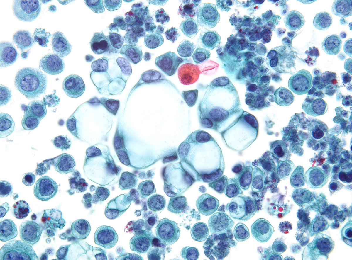 “Like Big Balloons”- Metastatic Esophageal Adenocarcinoma in Pleural Fluid. A pseudokeratotic cell is also noticed (totally nonspecific).