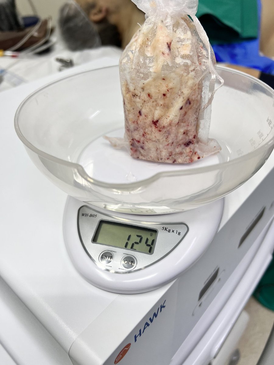 WestendarpM's tweet photo. Bipolar enucleation with Wolf equipment and Hawk morcescope. #bipolep #bph @filialendouro @urocencomex @HugoLopezRamos @trwherrmann https://t.co/dvzzLk2oRg