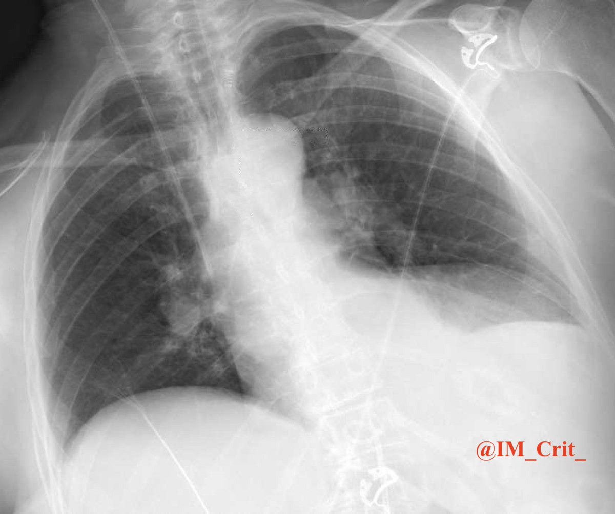 IM_Crit_'s tweet photo. ICU snapshots:

70 yo pt s/p total knee replacement 10 days ago was admitted with massive PE. Intubated in peri-arrest condition (POCUS: big failing RV) &amp; transferred to the ICU https://t.co/s6I5H0fyAn