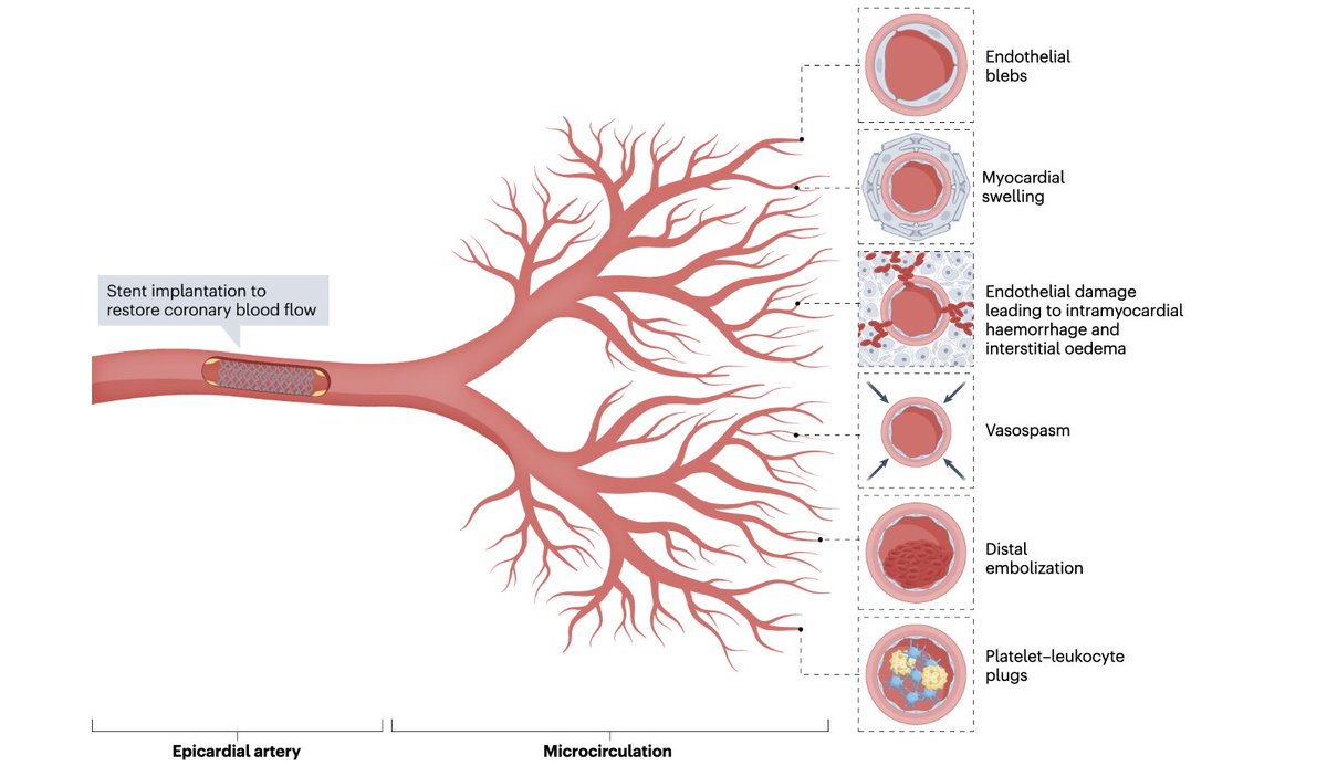 Salvatore Brugaletta (@sbrugaletta) on Twitter photo MVO should be a future target of treatment in STEMI patients. here the review led by <a href="/MattiaGalli10/">Mattia Galli</a> with all the dream team of alumni from <a href="/Unicatt/">Università Cattolica</a> <a href="/AbbateAntonio/">AntonioAbbate</a> <a href="/BURZOTTA_F/">FRANCESCO BURZOTTA</a> <a href="/ehj_ed/">EHJ Editor-in-Chief</a> <a href="/ItaloPorto2/">Italo Porto</a> <a href="/RoccoVergallo/">Rocco Vergallo</a> <a href="/RoccoMontone/">Rocco Montone</a> <a href="/hospitalclinic/">Hospital Clínic</a> <a href="/idibaps/">IDIBAPS</a> rdcu.be/drWH6 MVO should be a future target of treatment in STEMI patients. here the review led by <a href="/MattiaGalli10/">Mattia Galli</a> with all the dream team of alumni from <a href="/Unicatt/">Università Cattolica</a> <a href="/AbbateAntonio/">AntonioAbbate</a> <a href="/BURZOTTA_F/">FRANCESCO BURZOTTA</a> <a href="/ehj_ed/">EHJ Editor-in-Chief</a> <a href="/ItaloPorto2/">Italo Porto</a> <a href="/RoccoVergallo/">Rocco Vergallo</a> <a href="/RoccoMontone/">Rocco Montone</a> <a href="/hospitalclinic/">Hospital Clínic</a> <a href="/idibaps/">IDIBAPS</a> rdcu.be/drWH6