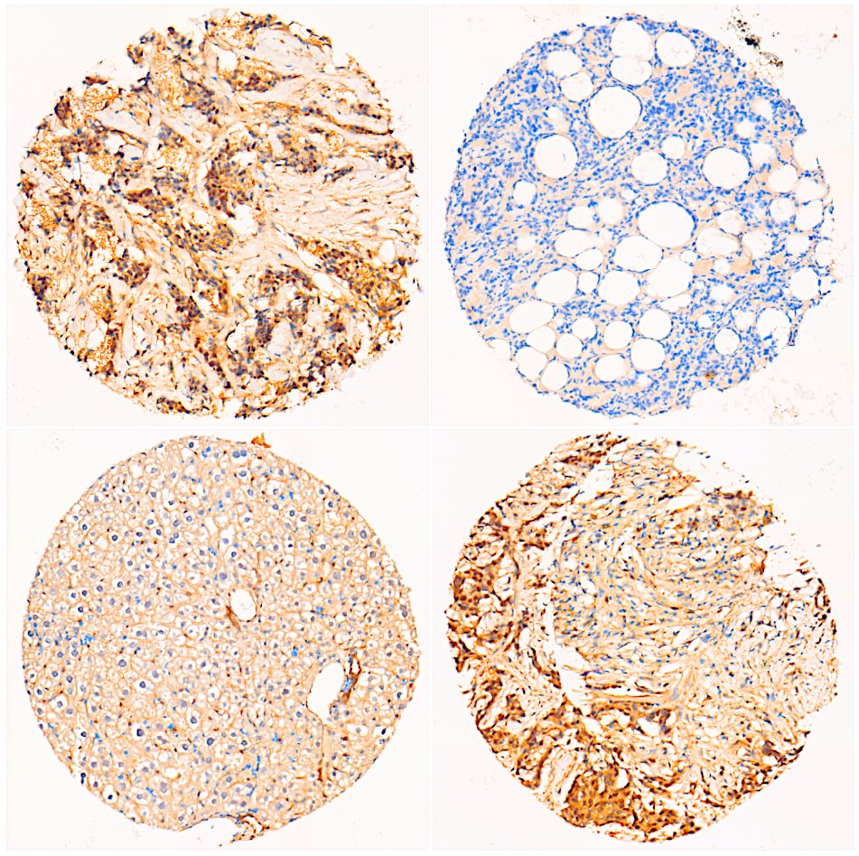 Cancers are not made up of a single population of cells, but rather a diverse array of different cell types, each with its own impact for cancer development and treatment response. 

🧵1/3