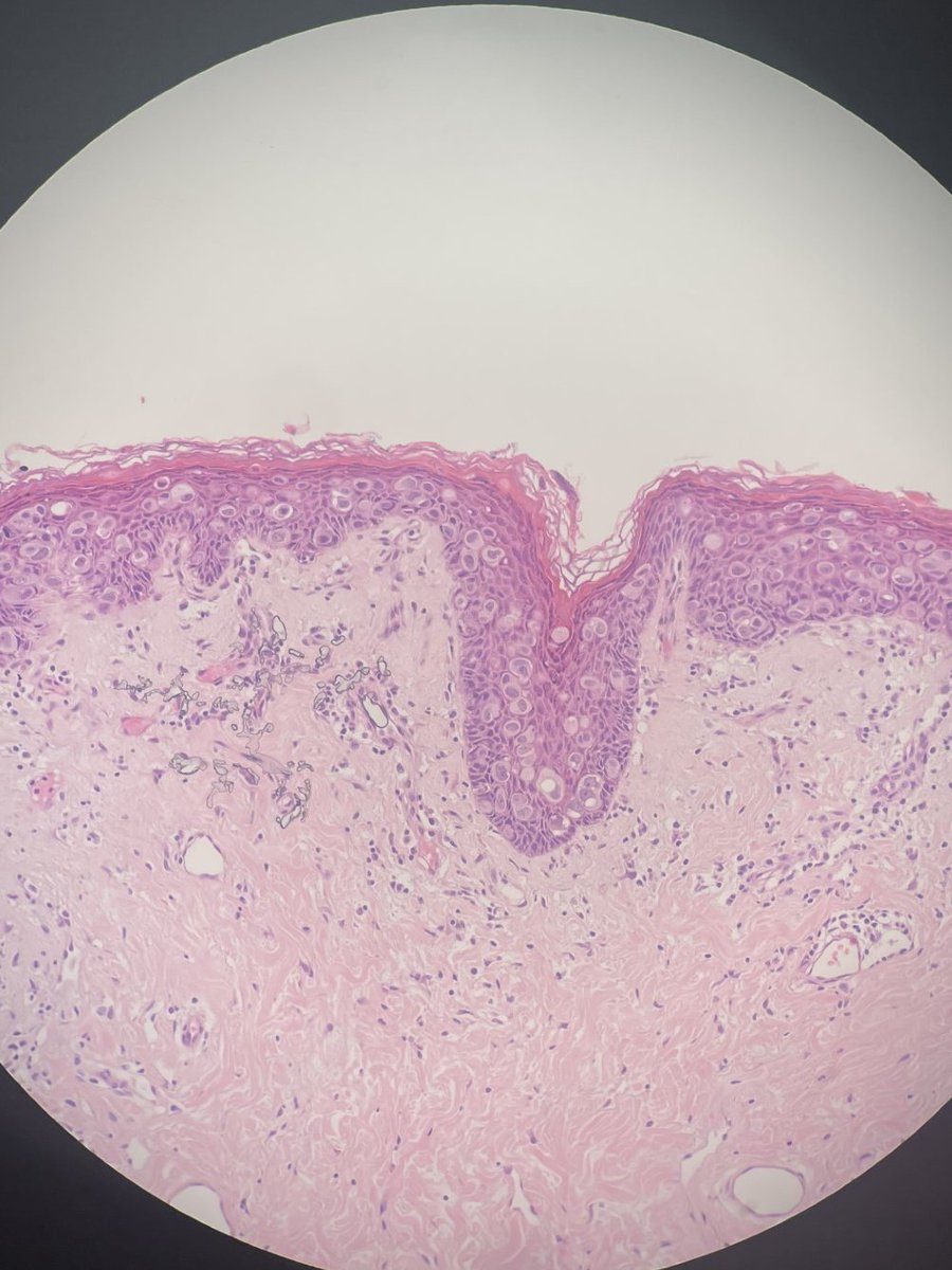 megothelioma's tweet photo. A great example of the famous Paget's disease of the breast. This is why we call the upward spread of atypical cells "Pagetoid".
#basicpath #pathtwitter #pathx https://t.co/Eg0NlLwHFi
