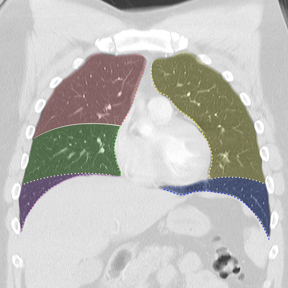 Lobar anatomy from my new CXR signs online course! 🫁 ANTERIOR CHEST: Horizontal fissure (white line), oblique fissures (white dotted line), R upper lobe (red), R middle lobe (green), R lower lobe (purple), L upper lobe (yellow), L lower lobe (blue). radiopaedia.org/courses/chest-…