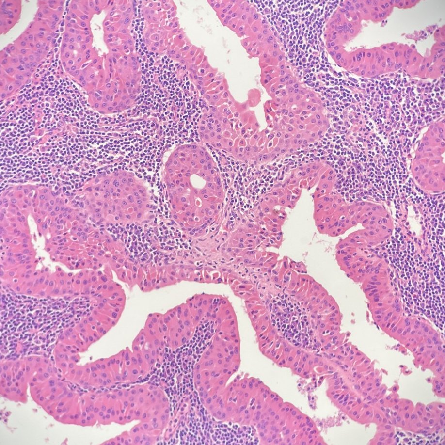 I can't just see a photogenic Warthin tumor and NOT post it. I'm only human. #entpath #pathtwitter #pathx