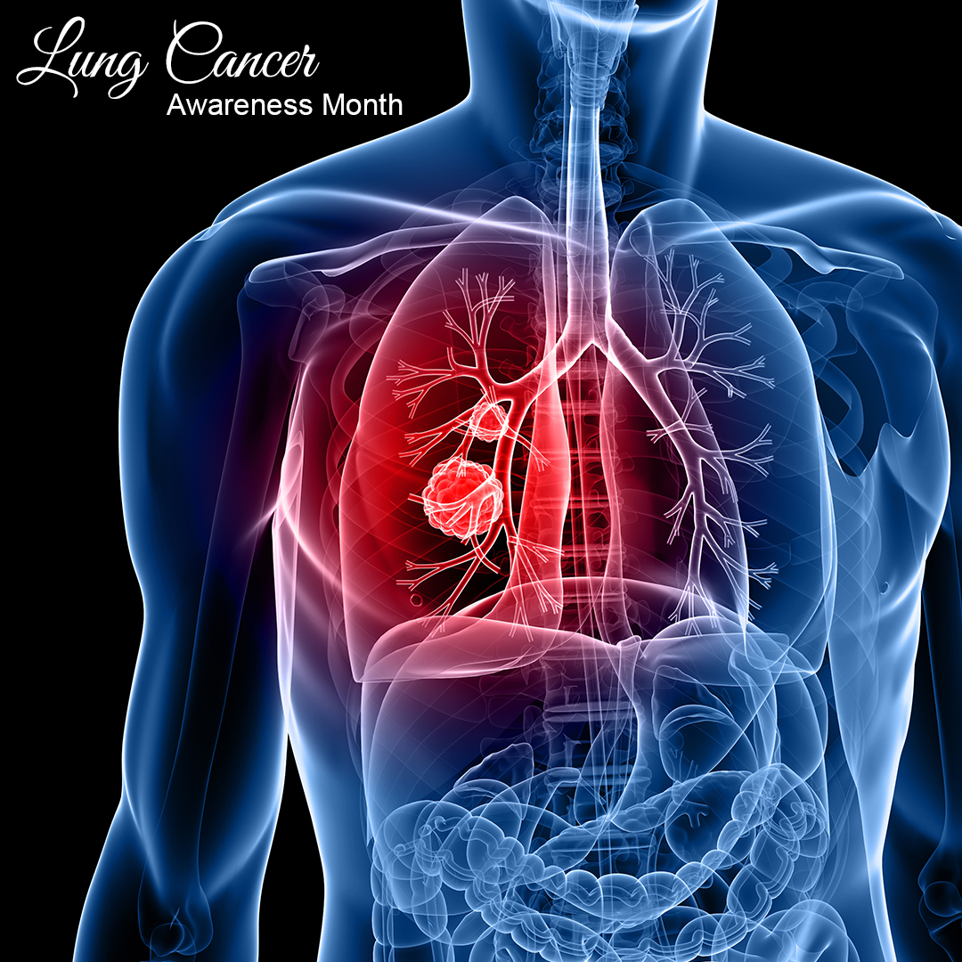 WrldwideLifeSci's tweet photo. November is Lung Cancer Awareness Month. Talk to your patients about the importance of how lung cancer is more luckily to be curable by getting screened early.

#Cancer #LungCancerResearch #CancerResearch #LivingWithCancer #StandUpToCancer #CancerSucks #Lungs #Breathe https://t.co/TwGHOr2iTr