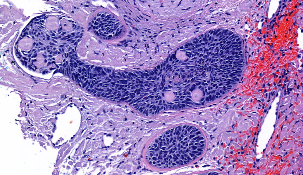 Cetacean basal cell carcinoma. Swimming in an ocean of keratinocyte-derived amyloid. With thickened basement membranes to boot.