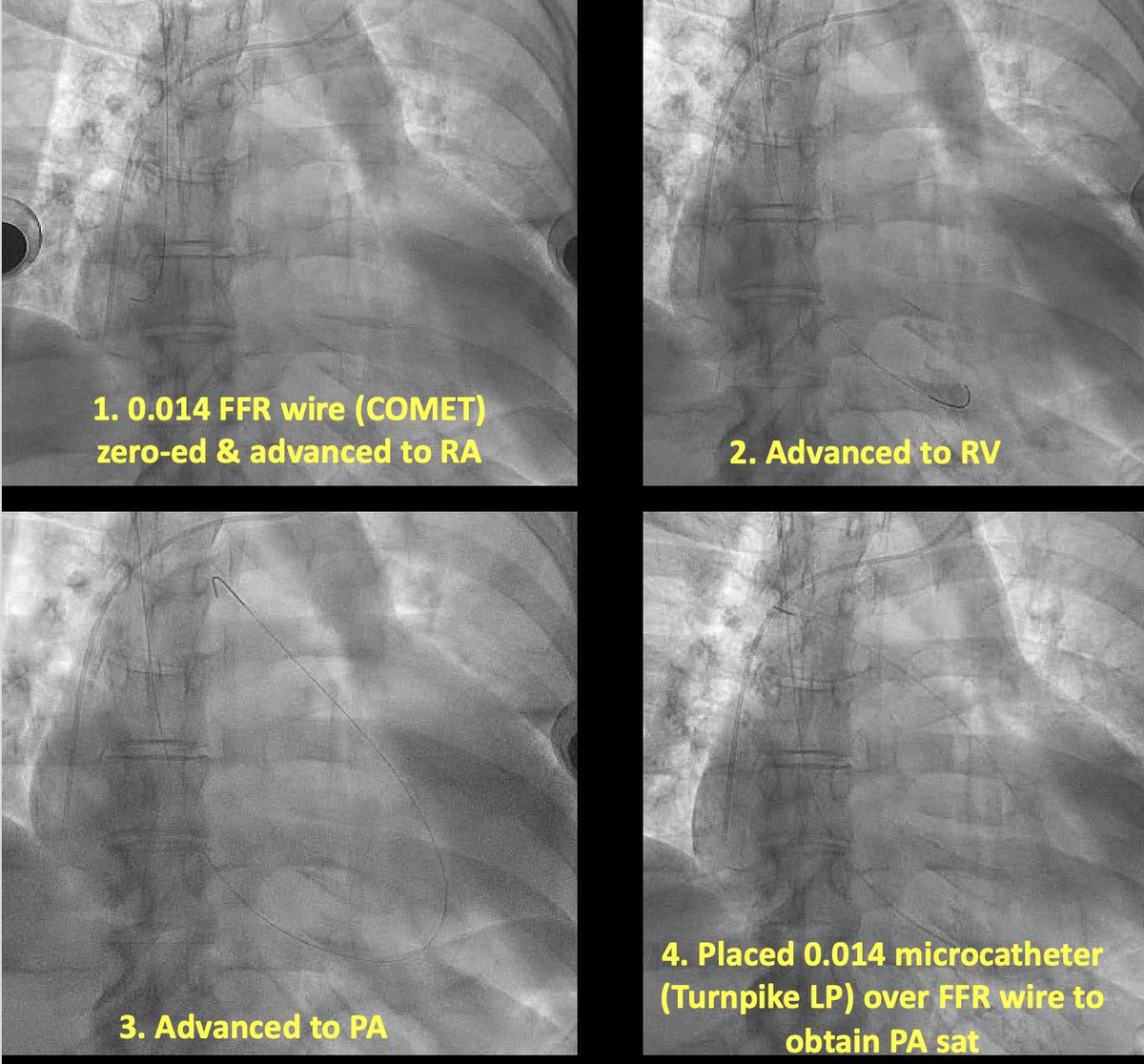 Umair2017's tweet image. Have u ever done a #RHC w/ #FFR pressure wire?

Pt w/ healed #tricuspid #endocarditis s/p 6 wks on IV antibiotics, now presenting w/ shock. Concern for using🎈wedge catheter 🦢, so used FFR wire 👇

#ACCFIT: What are 2 key RHC numbers missing this way?

#MedTwitter #cardioTwitter