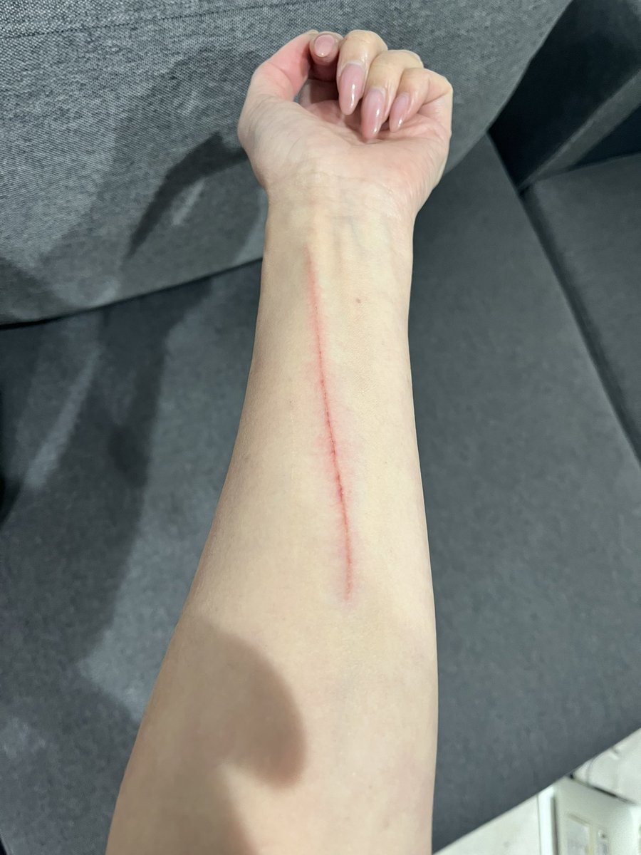 名古屋に向かってます🚄
昨日の朝、仕事行く前に、落ちてきた物がかすって、15センチのこんな傷ができてしまいました。。
今日のフェニックス撮影会やオフ会にご参加の皆様ごめんなさい🙇‍♀️
キズパワーパッド貼ると目立たないかも。

元気にお会いしましょうー☀️ https://t.co/KkS4lObJ7z