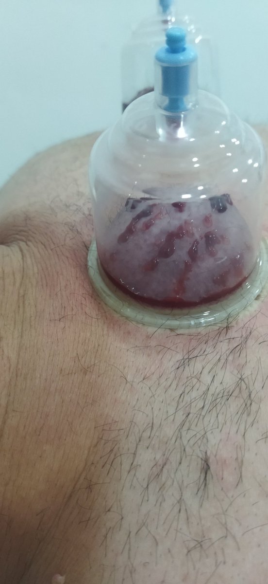 MasorTedavi's tweet photo. Hacamat sullukte tek adres havalar soğudu sağlığa dikkat edilmesi gerektiğini hepimiz biliyoruz... https://t.co/XNVHO5AU9K