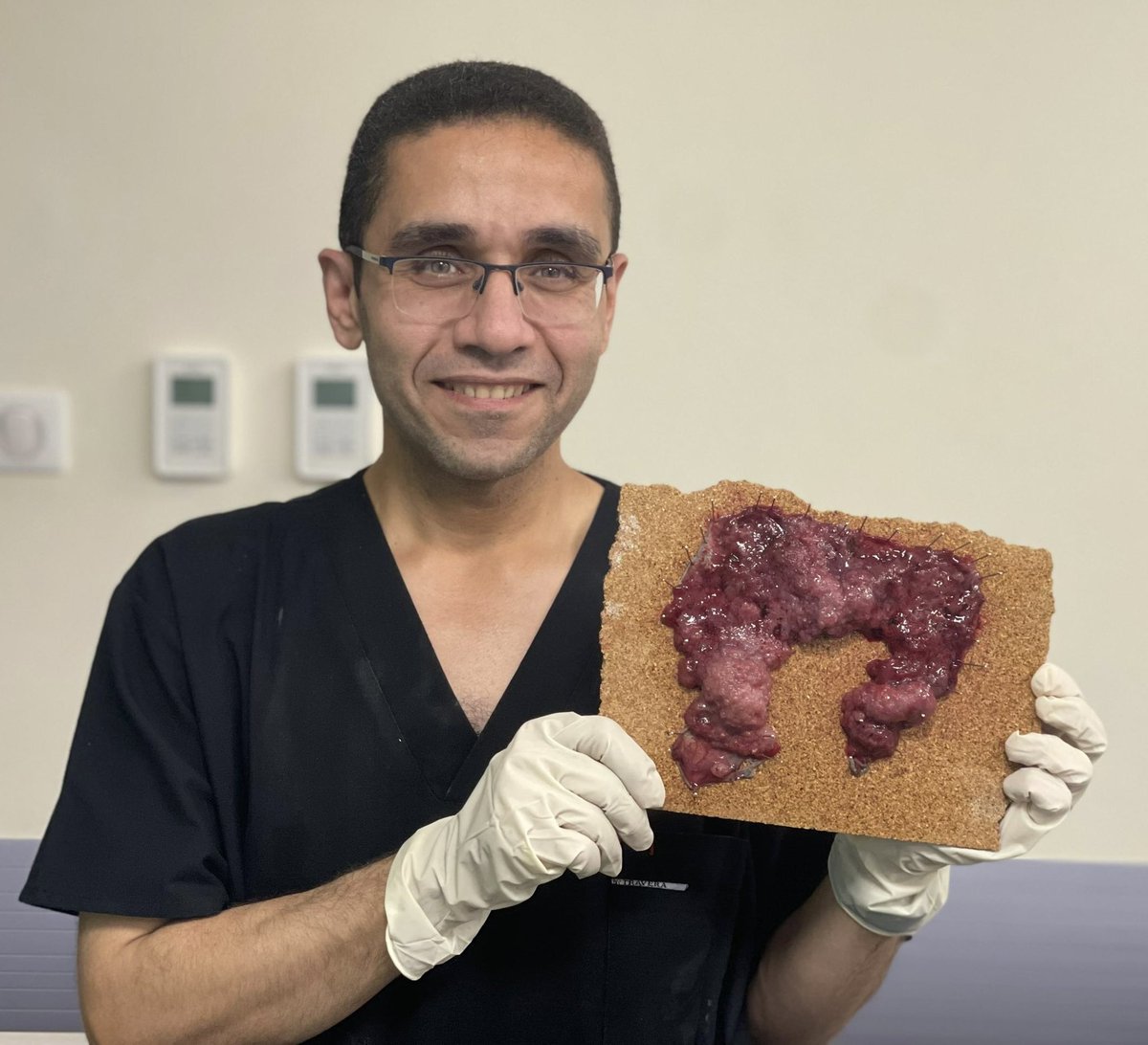 Ahmad.Madkour (@ahmad_madkour) on Twitter photo It’s not surgical specimen
It result of ESD for 33 Cm anorectal LST ✌️
The fun of interventional endoscopy
Greetings from Egypt😎<a href="/alerepici/">alessandro repici</a>
<a href="/AkwiAsombangMD/">Akwi Asombang MD MPH</a> <a href="/Taalamri/">Turki AlAmri |تُرْكي عبدالله الْعَمريَّ MD</a> <a href="/EndoscopyOthman/">Mohamed Othman</a> @EHolzwanger <a href="/SunilAminMD/">Sunil Amin, MD, FASGE, FRCPC</a> <a href="/EndoCollabcom/">EndoCollab™ | GI Endoscopy Community</a> <a href="/ASGEendoscopy/">ASGE GI Endoscopy</a> It’s not surgical specimen
It result of ESD for 33 Cm anorectal LST ✌️
The fun of interventional endoscopy
Greetings from Egypt😎<a href="/alerepici/">alessandro repici</a>
<a href="/AkwiAsombangMD/">Akwi Asombang MD MPH</a> <a href="/Taalamri/">Turki AlAmri |تُرْكي عبدالله الْعَمريَّ MD</a> <a href="/EndoscopyOthman/">Mohamed Othman</a> @EHolzwanger <a href="/SunilAminMD/">Sunil Amin, MD, FASGE, FRCPC</a> <a href="/EndoCollabcom/">EndoCollab™ | GI Endoscopy Community</a> <a href="/ASGEendoscopy/">ASGE GI Endoscopy</a>