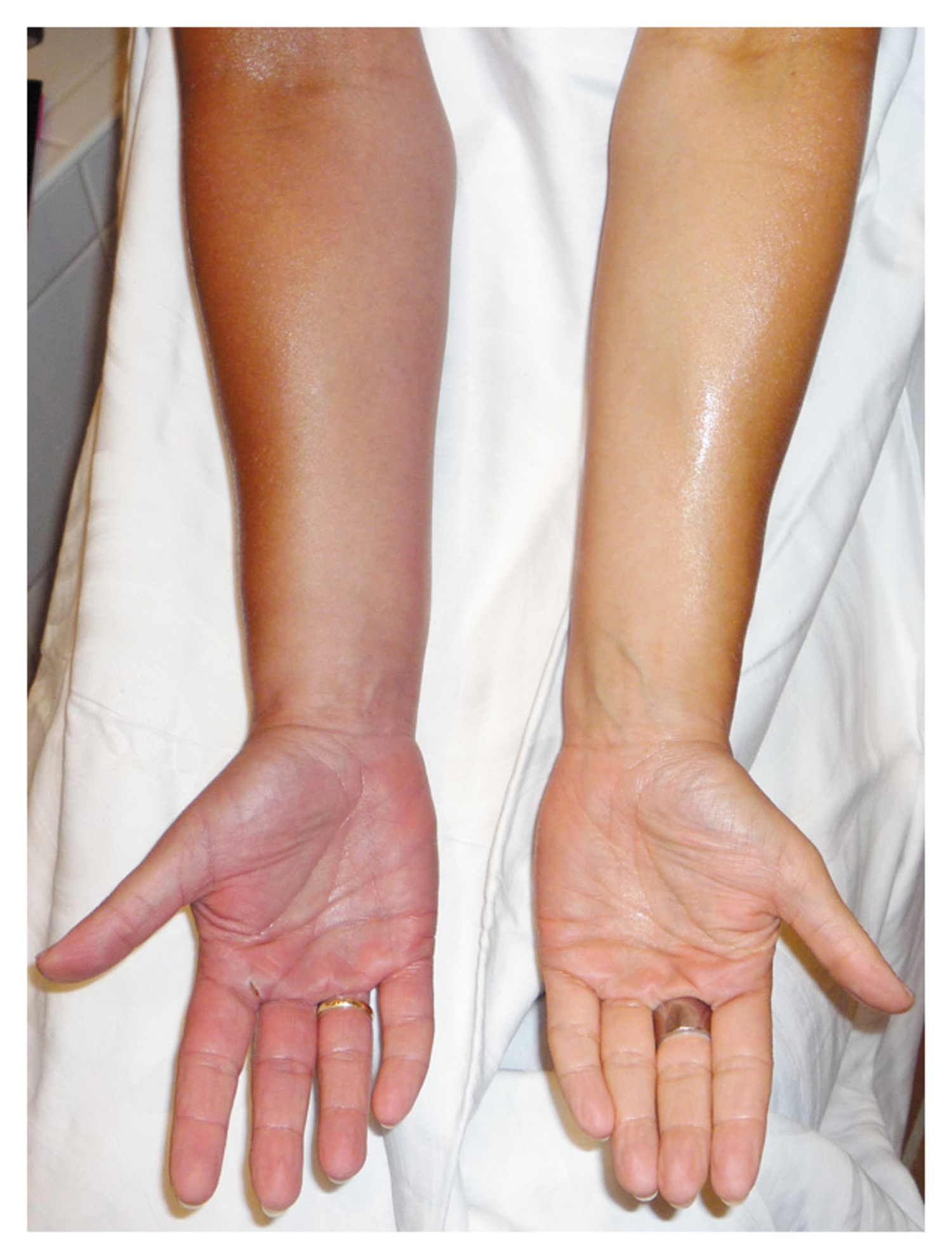 Pain in right arm and hand deals
