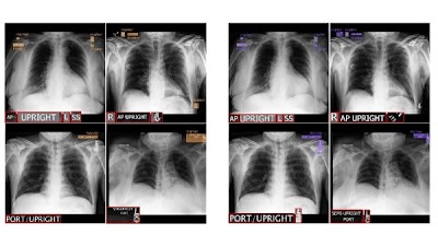 Object-detection #DeepLearning model removes radiographic markers to anonymize images doi.org/10.1148/ryai.2… <a href="/Mayo_OSAIL/">MayoOSAIL</a> <a href="/MayoRadiology/">Mayo Clinic Radiology</a> <a href="/CodyWylesMD/">Cody Wyles</a> #deidentification #ML #MachineLearning