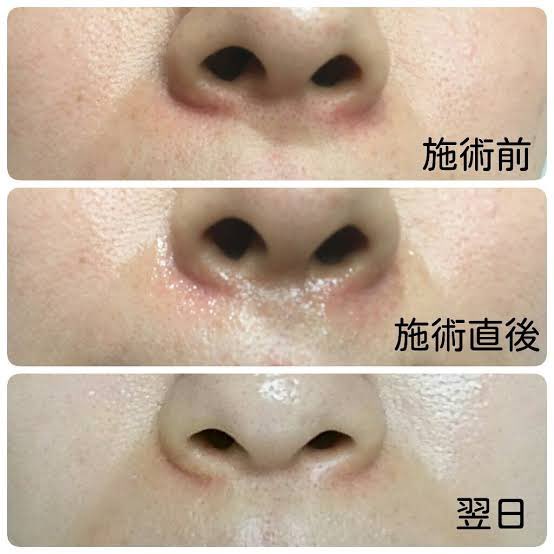 tsukino_bi's tweet photo. 日本人に多い、ブルベ夏
皮膚薄くて毛細血管拡張症なりがち

保険適用で治せるし、赤みが引くと中顔面の陥没感や脂性感が緩和できる

私は外側小鼻と人中するときにぶった斬ってもらった🤣 https://t.co/EMuMoyrDeh